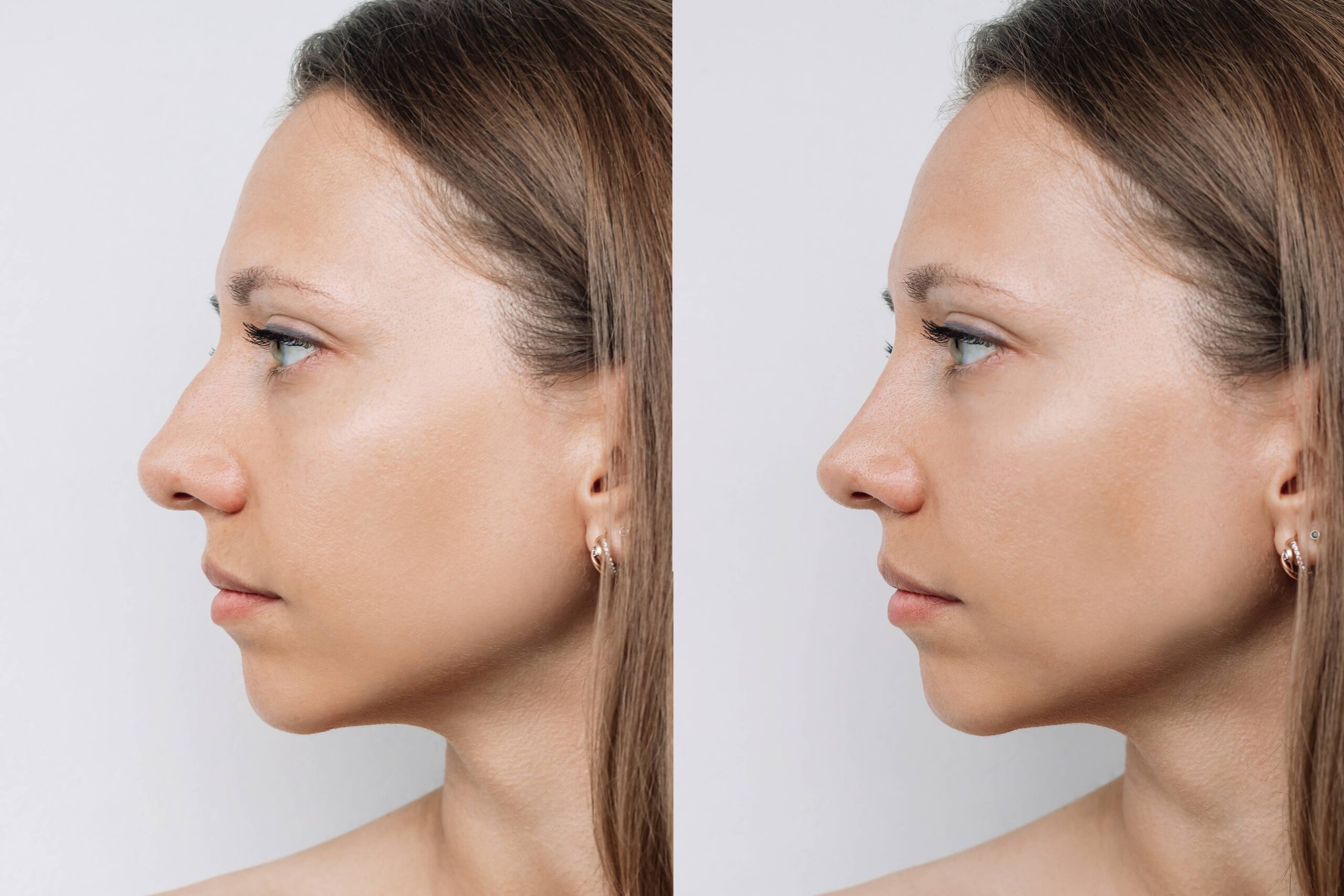 rinoplastia.final